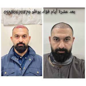 تركيا زراعة الشعر فؤاد بوظو غازي عنتاب